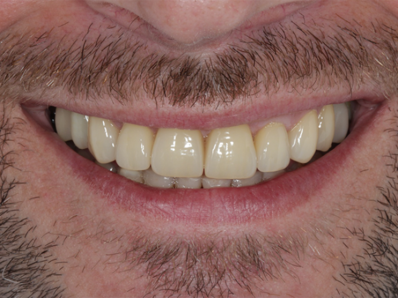 Implantes Dentales