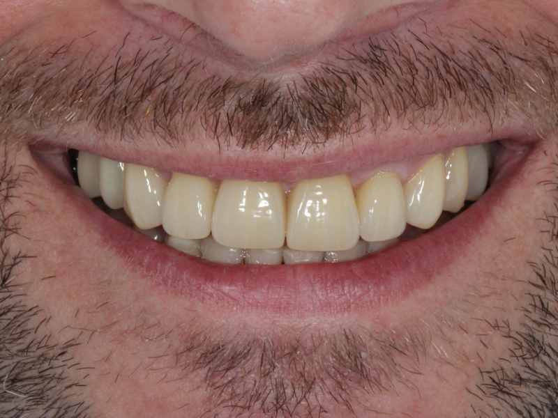 Implantes Dentales