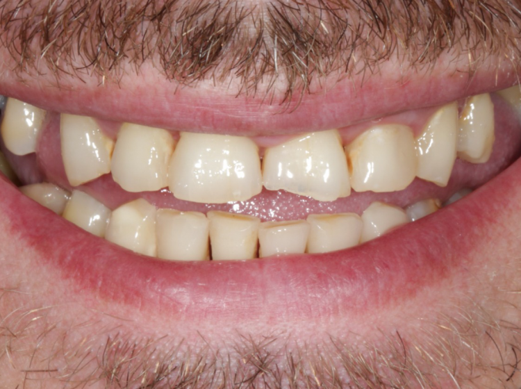 Implantes Dentales