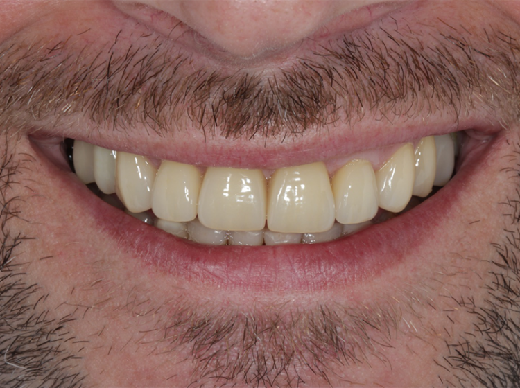 Implantes Dentales