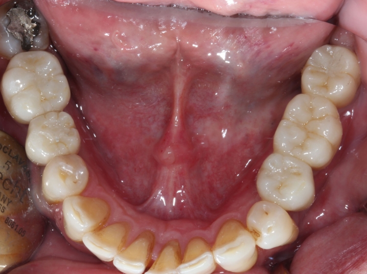 Puente sobre implantes dentales: