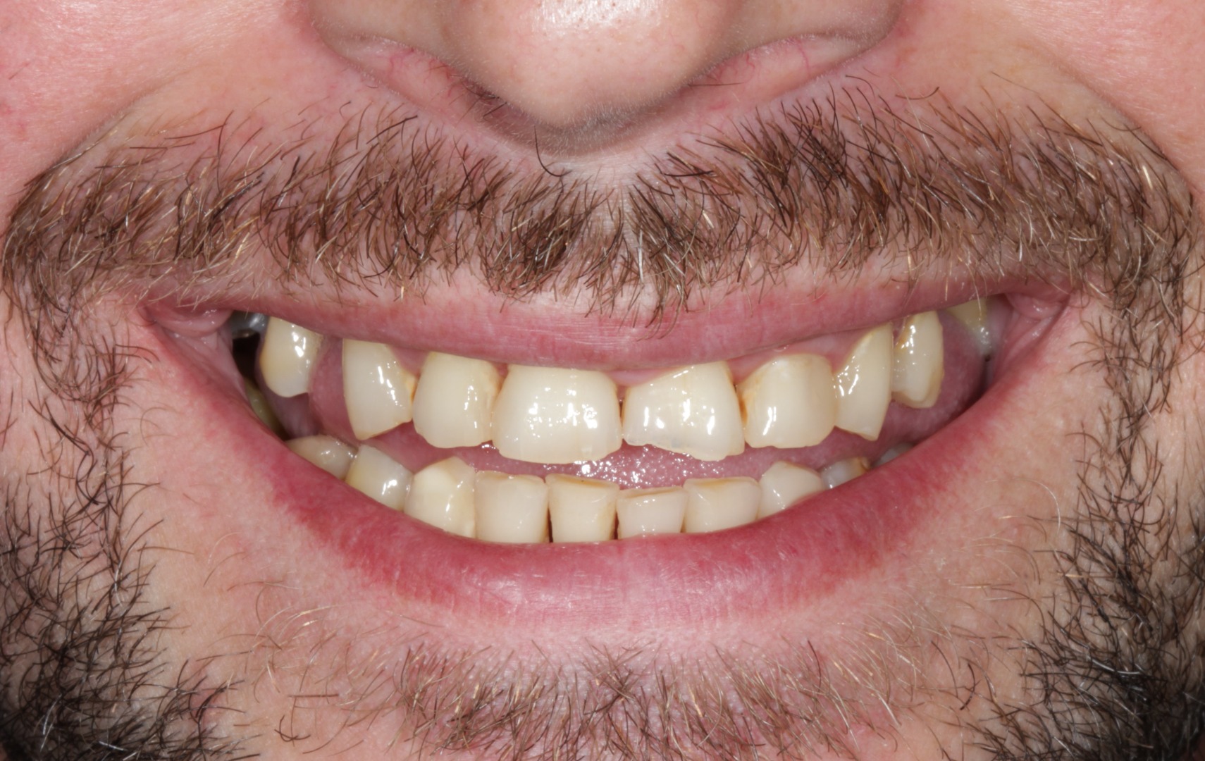 Implantes Dentales